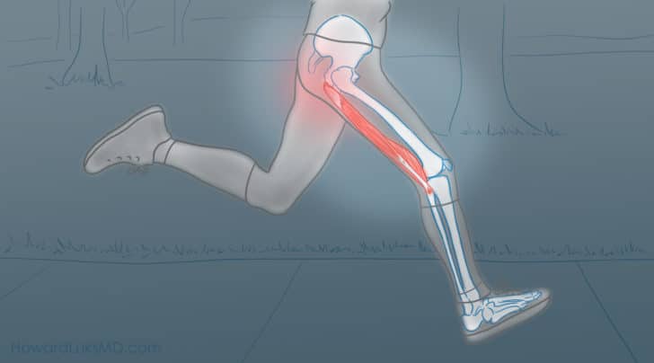 tendinopatía proximal de los isquiotibiales PHT