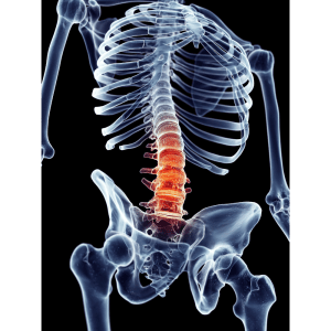 Tratamiento de la fractura de columna lumbar y torácica