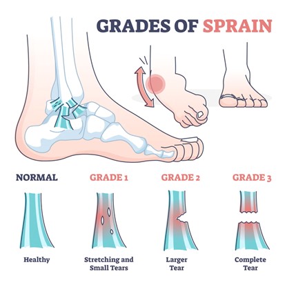 Un diagrama de un pie que muestra los diferentes grados de esguince de tobillo, incluidos los normales o sanos, el desgarro pequeño de grado 1, el desgarro grande de grado 2 y el desgarro completo de grado 3.