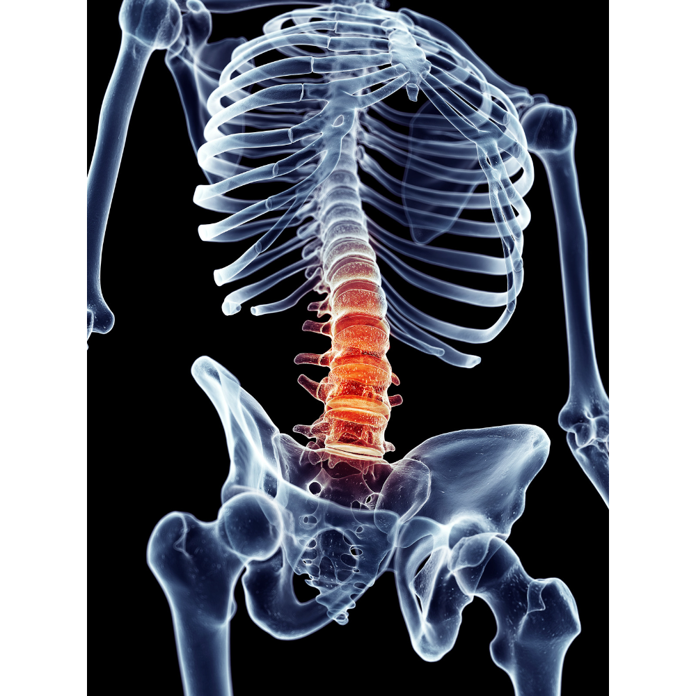 Tratamiento de la fractura de columna lumbar y torácica